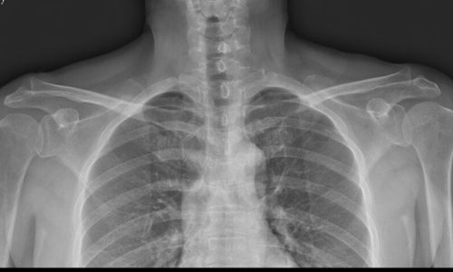 bothshoulder.Seq1.Ser1.Img1