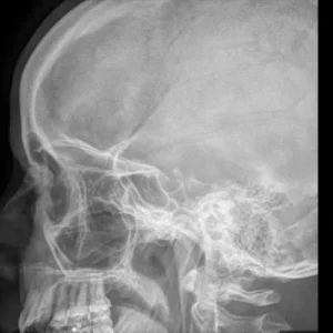sinus lat